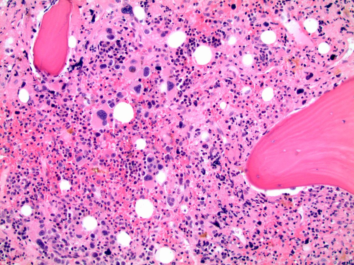 Bone marrow biopsy 200X